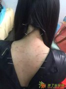 全国师资最强大的中医壮医针灸,南宁针灸推拿培训