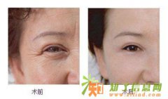 泰安除皱哪家好，泰安面部除皱哪家好