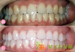 无锡学美牙大概多少钱？