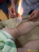 广西精专针灸学校 快康精品针灸课学习针灸so easy