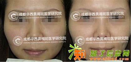 色素沉着竟有着么多危害？