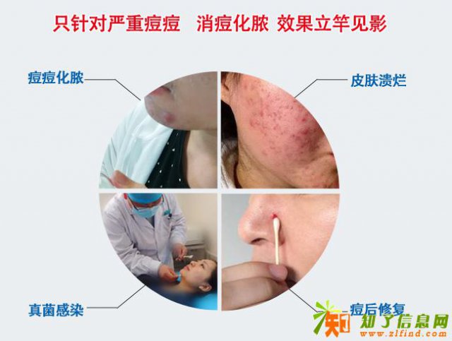 2018微商爆款消炎祛痘精微水推荐