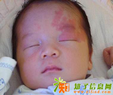 通过成都川蜀认识到蔓性血管瘤居然有这么大的危害