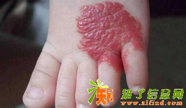 成都川蜀对海绵状血管瘤临床总结