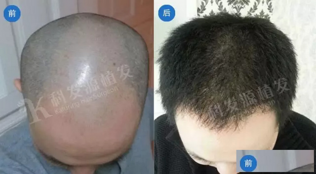 南昌科发源植发让你的头发重获新生