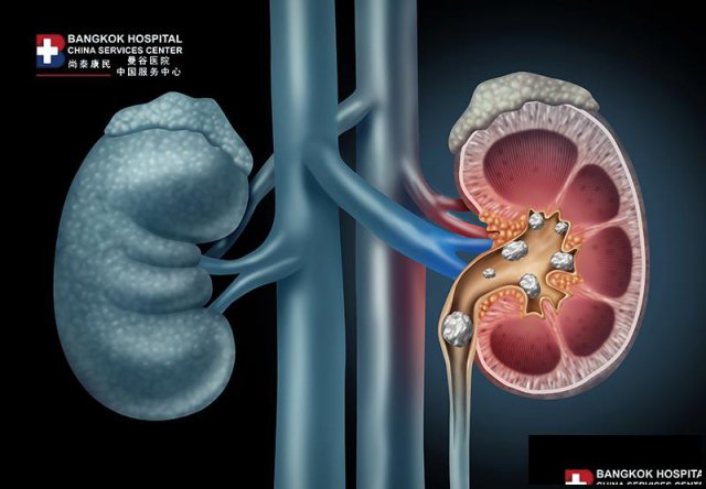 泰国曼谷医院泌尿中心|肾结石