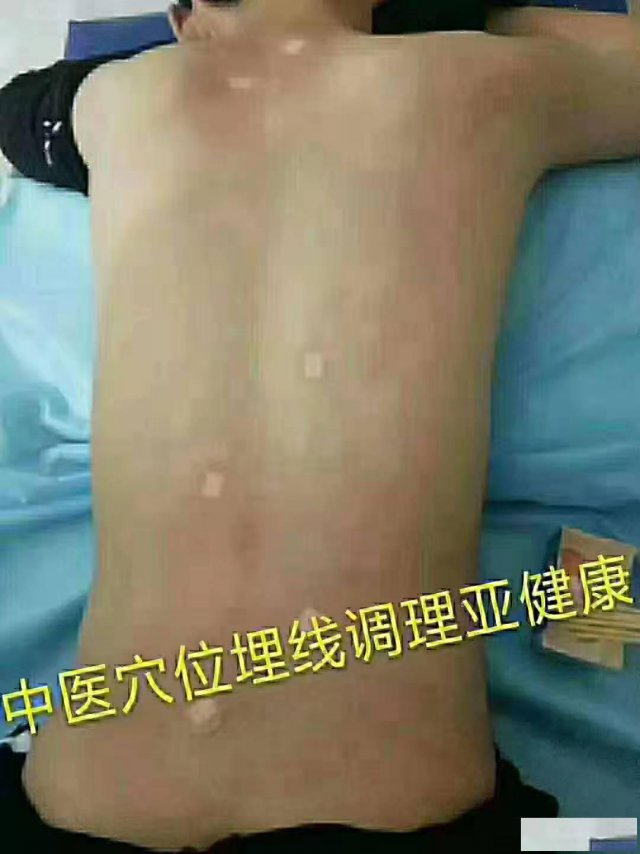 穴位埋线学习（疼痛、减肥、美容专题）技术