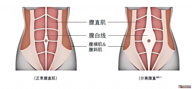 生娃后，肚子减不下去问题出在哪呢