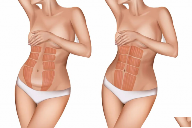 腹直肌分离：产后妈妈的隐形困扰与解决之道