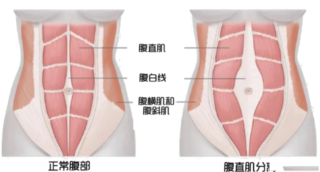 产后肚子隆起、皮肤松弛？可能是腹直肌分离！