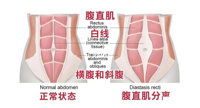 产后恢复难题：腹直肌分离如何有效应对？