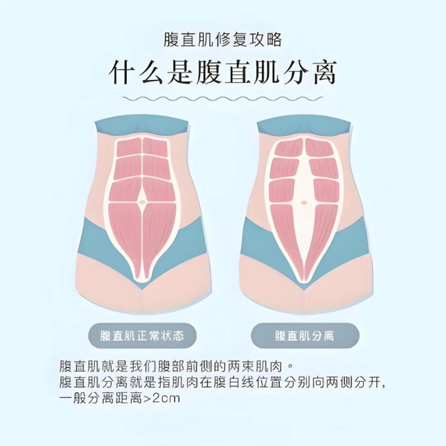 产后身材变形？腹直肌&quot;归位&quot;其实很简单