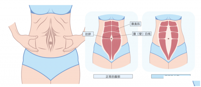 腹直肌分离：产后妈妈的隐形挑战与科学应对
